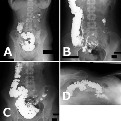 Pdf Mobile Cecum In A Young Woman With Ehlers Danlos Syndrome Pdf Mobile Cecum In A Young Woman With Ehlers Danlos Syndrome