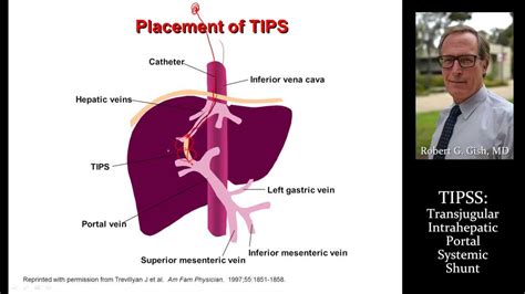 Tips Procedure Tips Procedure