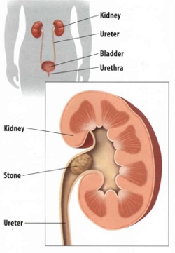 Urology Associates Shockwave Technology Urology Associates Shockwave Technology